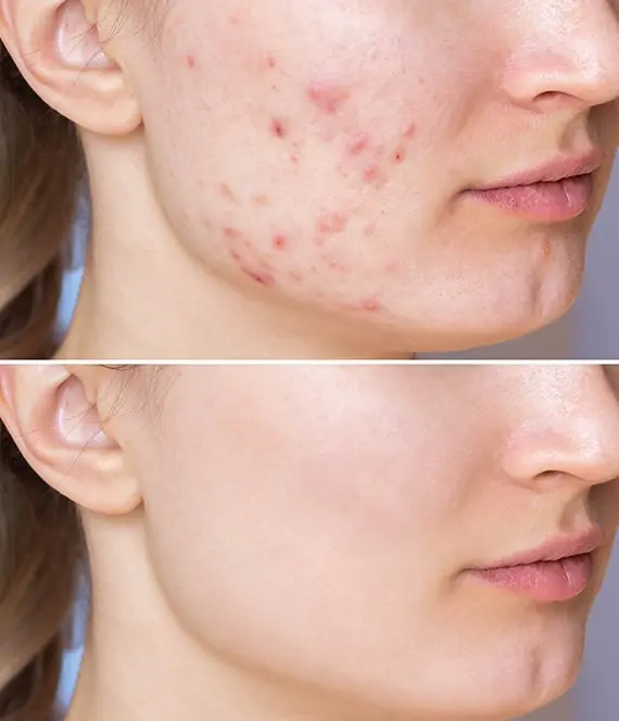 Skin needling melbourne before and after