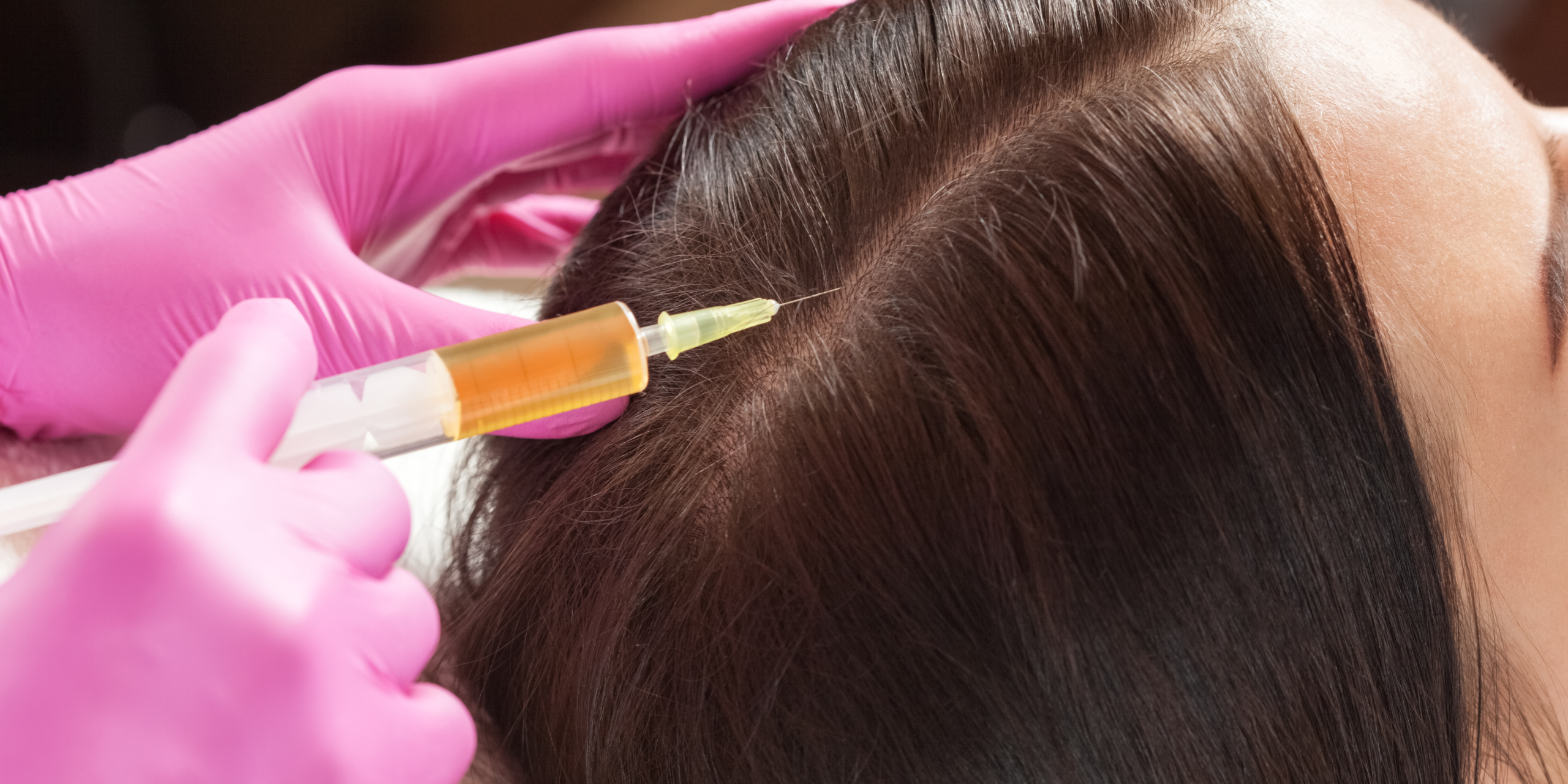 Benefits of PRP for hair loss