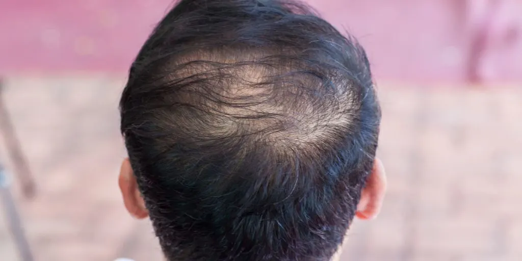 Why More Men in Melbourne Are Choosing PRP for Hair Loss